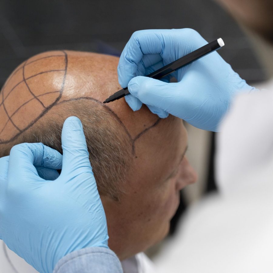 male-going-through-follicular-unit-extraction-process